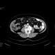 Sclerosing mesenteritis: CT - Computed tomography